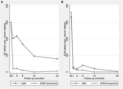 Lamellar macular defects: are degenerative lamellar macular holes truly degenerative?